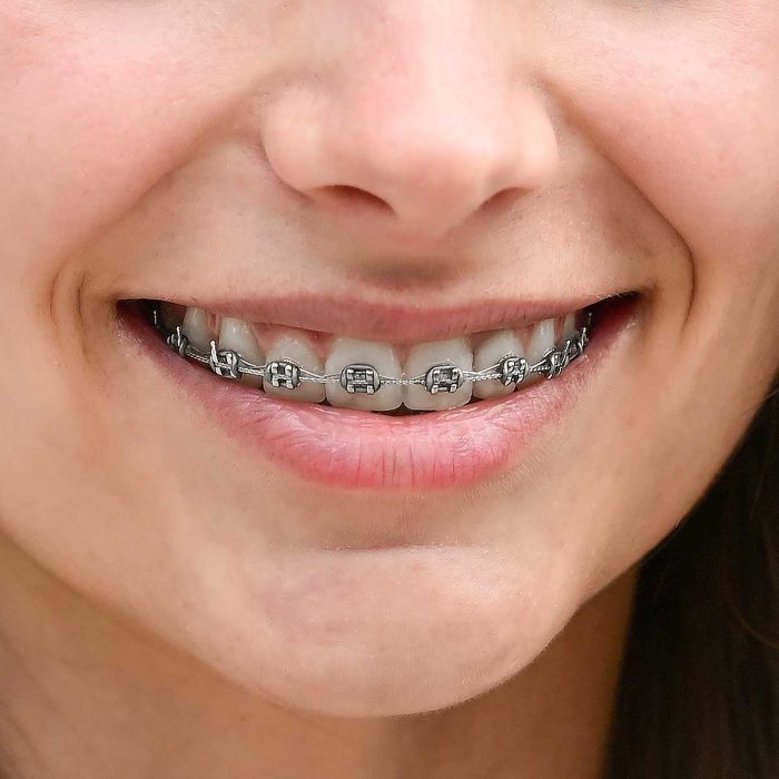 metallbrackets_524462383 metallbrackets_524462383