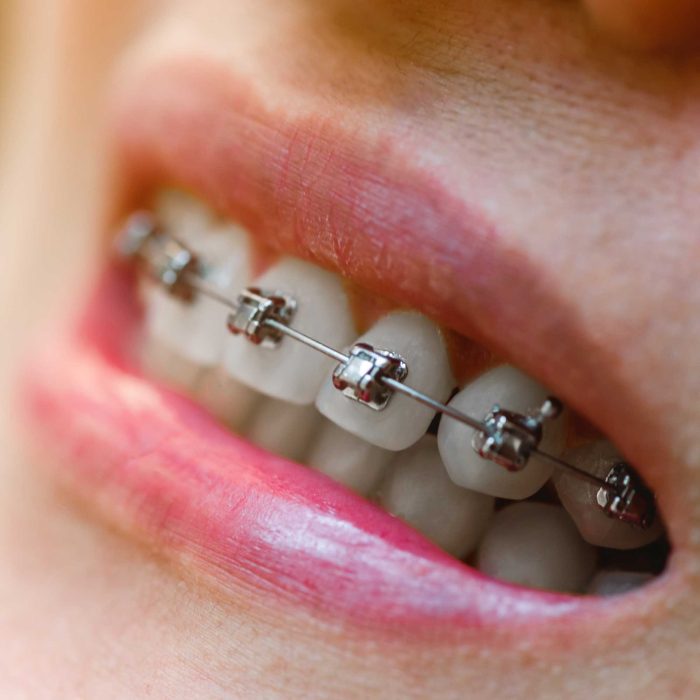 selbstligierende-brackets-i-1457726850 selbstligierende-brackets-i-1457726850